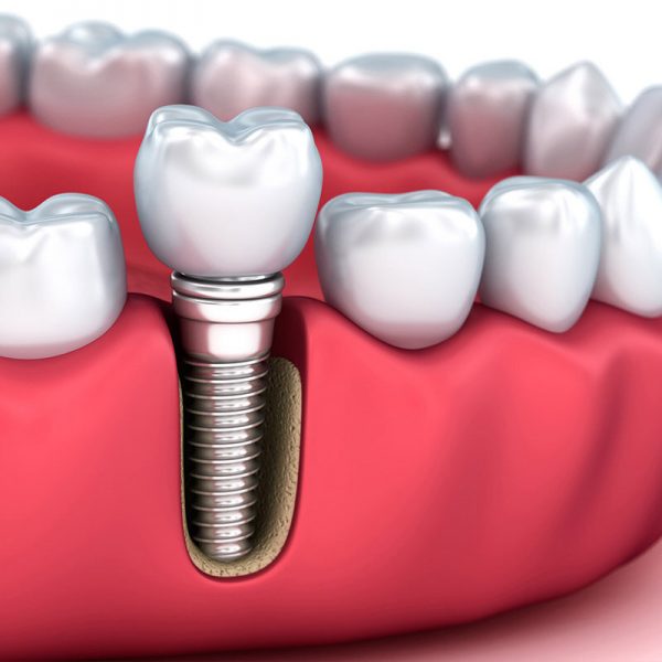 عکس بریج و روکش-درمانگاه دندانپزشکی آپادانا